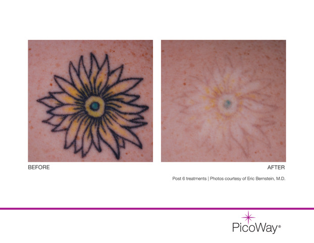 6 Success Factors of Tattoo Removal  Kitagawa Dermatology
